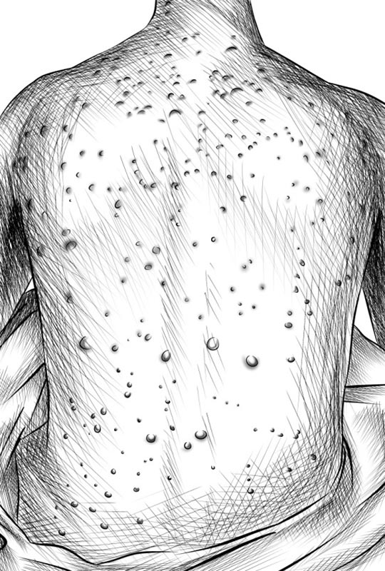 Chickenpox is an airborne disease which spreads easily through coughing or sneezing of ill individuals or through direct contact with secretions from the rash. A person with chickenpox is infectious one to two days before the rash appears. The disease causes fever, skin lesions and also ulcers in the mouth and tonsil areas. The disease is usually more severe in adults, especially men.